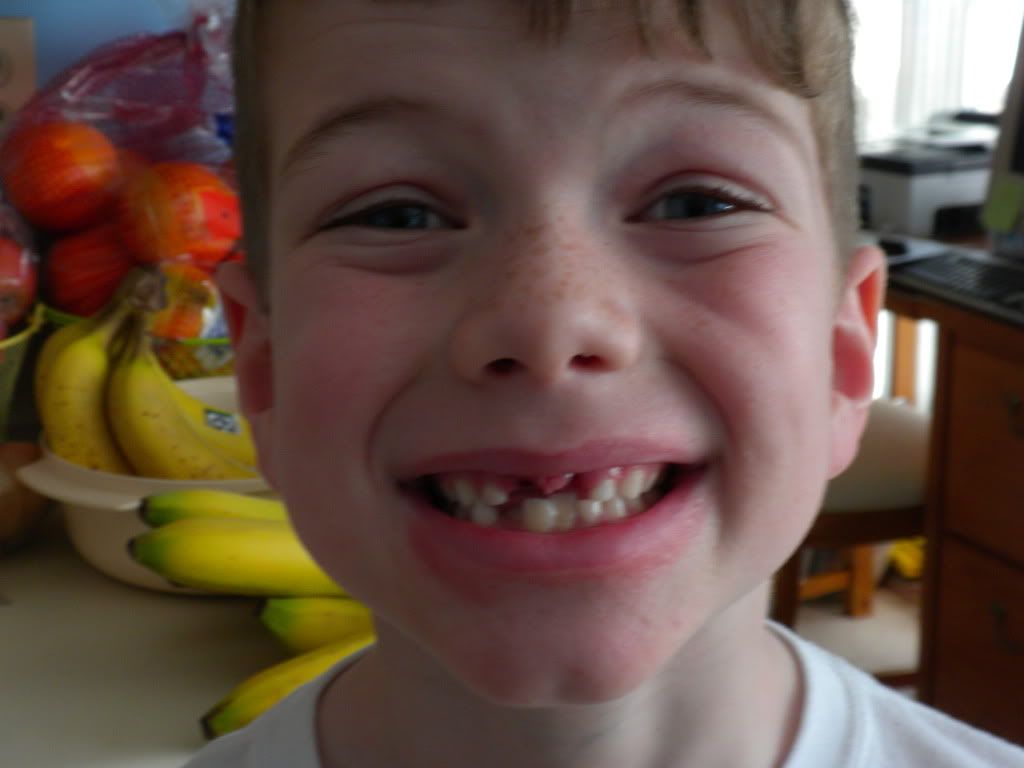 teeth,missing teeth,teeth knocked out,little kid loses a tooth